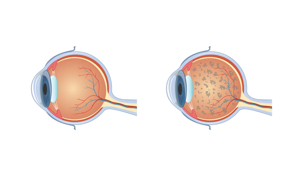 מדוע הילד שלי לא רואה?
