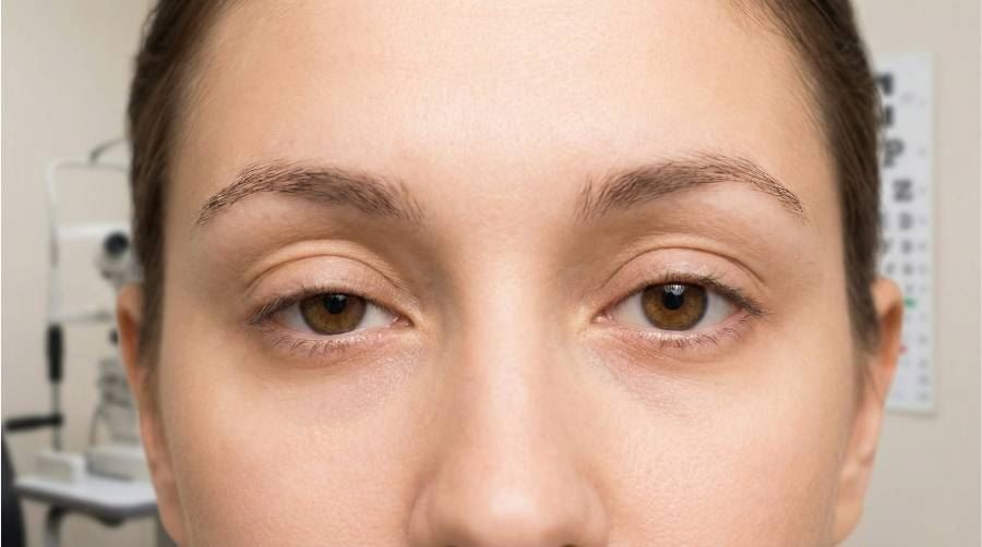 צניחת עפעף בעין אחת, פטוזיס קל בעפעף העליון עם אסימטריה בגובה העפעפיים.